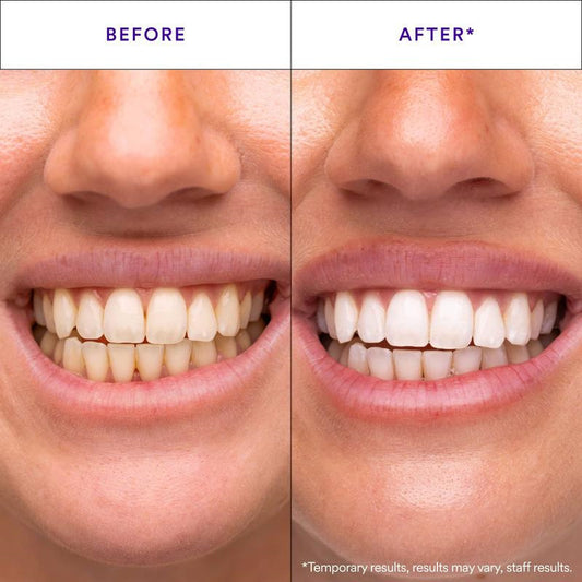 V34 Teeth Whitening Strips